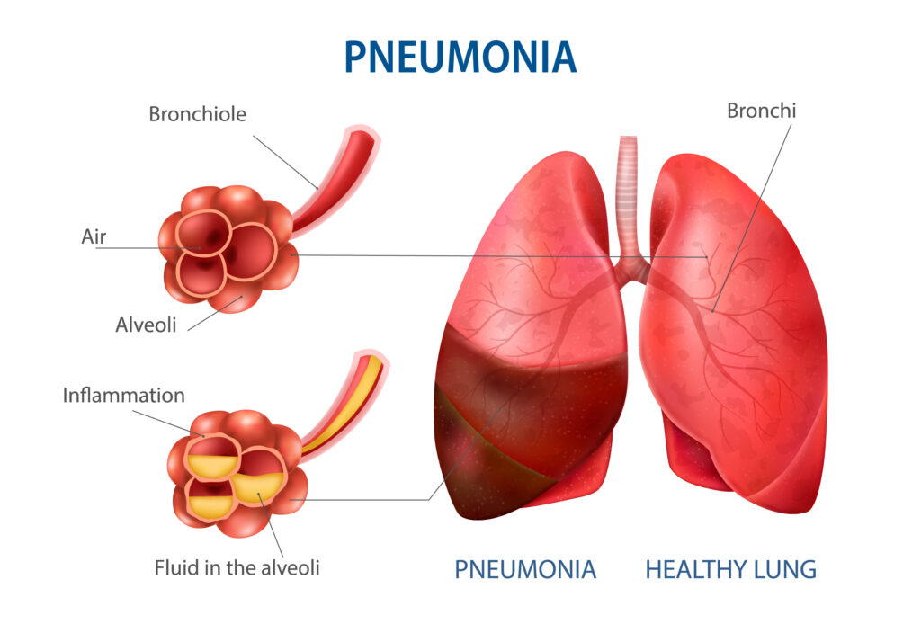 Penyebab Pneumonia