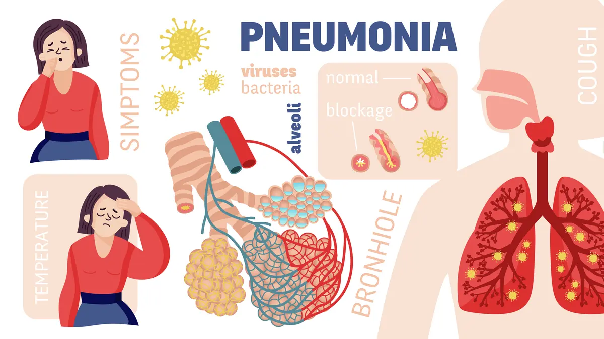 3 Cara Mencegah Penyakit Pneumonia dan Kenali Penyebab nya